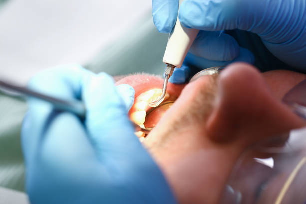 Best Emergency Dental Care for Broken or Chipped Teeth in Baden, MD